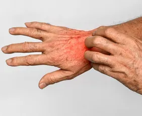 Imagem ilustrativa da imagem Governo de Minas Gerais orienta medidas de controle após surto de sarna humana