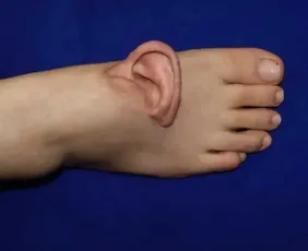 Imagem ilustrativa da imagem Médicos chineses enxertam orelha em pé de paciente