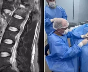 Imagem ilustrativa da imagem Paciente que recebeu polilaminina relata emoção ao mexer o pé e a perna