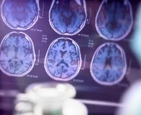 Imagem ilustrativa da imagem Alzheimer é a segunda doença mais temida pelos brasileiros, atrás apenas do câncer