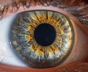 Imagem ilustrativa da imagem Bactéria comum no olho pode estar ligada à piora do Alzheimer, diz estudo