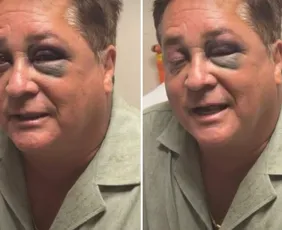 Imagem ilustrativa da imagem Cantor Leonardo sofre acidente e aparece com os olhos roxos e inchados