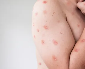 Imagem ilustrativa da imagem Espírito Santo confirma segundo caso de Mpox em 2026