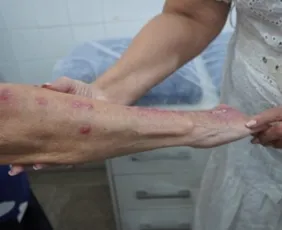 Imagem ilustrativa da imagem Esporotricose humana entra na lista de notificação compulsória no Brasil