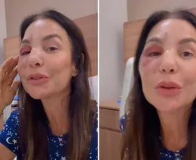 Imagem ilustrativa da imagem Ivete Sangalo ressurge após cirurgia no rosto: 'Poderia ter sido tão pior'