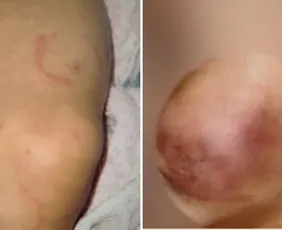 Imagem ilustrativa da imagem Mãe e padrasto são presos suspeitos de agredir bebê com mordidas em Vila Velha