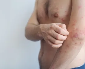 Imagem ilustrativa da imagem Ministério da Saúde alerta para risco de casos de sarampo após Copa