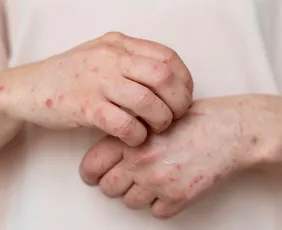 Imagem ilustrativa da imagem Ministério da Saúde emite alerta para reintrodução do sarampo após a Copa do Mundo