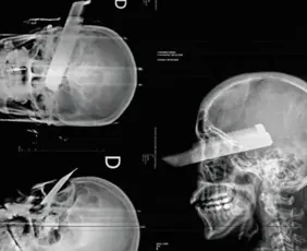 Imagem ilustrativa da imagem Mulher fica com faca cravada no olho após tentativa de feminicídio em SC