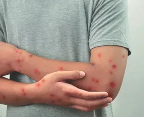 Imagem ilustrativa da imagem Saiba como se proteger da mpox; Brasil já registrou 57 casos neste ano