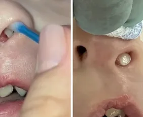 Imagem ilustrativa da imagem Em caso raro, dente nasce dentro do nariz de criança de 3 anos no Paraná