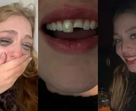 Imagem ilustrativa da imagem Jovem quebra dente na balada, cola na madrugada e volta para a festa