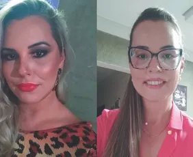 Imagem ilustrativa da imagem "Vivia 24 horas com muita dor", conta influenciadora que recebeu aplicação de PMMA