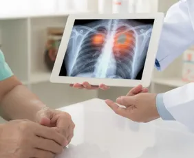 Imagem ilustrativa da imagem Anvisa aprova novo medicamento para câncer de pulmão avançado