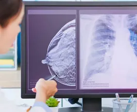 Imagem ilustrativa da imagem IA já ajuda médicos na detecção do câncer de mama