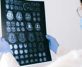 Imagem ilustrativa da imagem Pesquisadores desenvolvem método para prever Alzheimer antes dos primeiros sinais