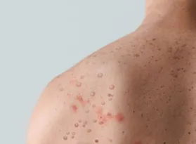 Imagem ilustrativa da imagem Nova varíola é transmitida pelo sexo em 95% das vezes
