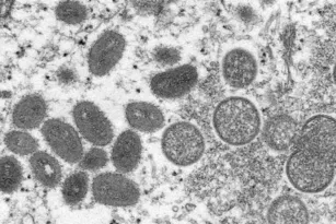 Imagem ilustrativa da imagem Diagnóstico de nova varíola será feito nos Lacens até agosto, diz ministro