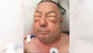 Imagem ilustrativa da imagem Idoso sofre complicação após cirurgia e fica com rosto desfigurado