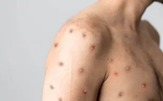 Imagem ilustrativa da imagem ES chega a 135 casos confirmados de nova varíola. Veja o perfil dos pacientes