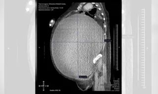 Imagem ilustrativa da imagem Mulher perde 53 kg após passar por cirurgia para remover cisto gigante