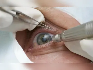 Imagem ilustrativa da imagem Médicos alertam para riscos de cirurgia de mudança da cor dos olhos