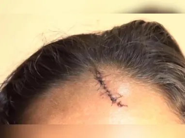 Imagem ilustrativa da imagem Mulher é agredida pelo ex-marido com garrafada na cabeça durante briga em Cariacica