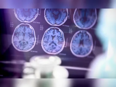 Imagem ilustrativa da imagem Novas drogas contra Alzheimer são avanço no tratamento, dizem especialistas