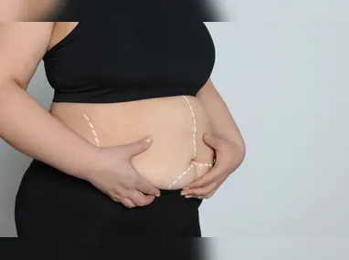 Imagem ilustrativa da imagem Após novas regras, mais jovens buscam por cirurgia bariátrica