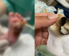 Imagem ilustrativa da imagem Técnica em Enfermagem não teve intenção de queimar bebê em hospital, diz PC