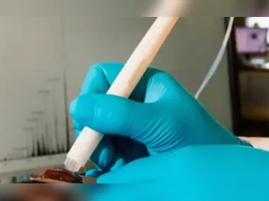 Imagem ilustrativa da imagem Caneta que detecta câncer durante cirurgia chega ao País