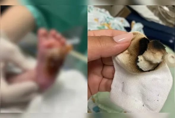 Bebê sofreu queimaduras de terceiro grau no pé