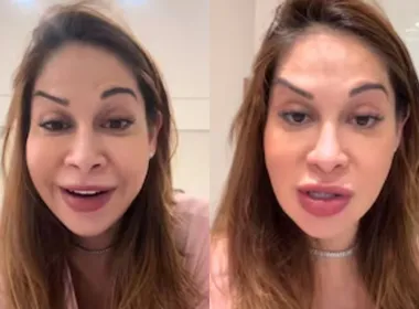Imagem ilustrativa da imagem Maíra Cardi exibe rosto deformado após botox dar errado: 'Olha que palhaçada'