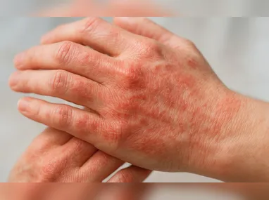 Imagem ilustrativa da imagem Brasil segue líder mundial em mortes por Chagas, aponta estudo