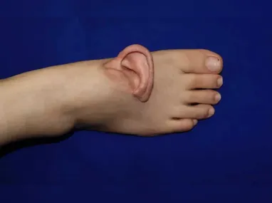 Aplicação de ácido hialurônico é o procedimento mais usado na harmonização