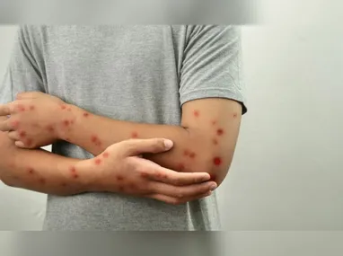 Imagem ilustrativa da imagem Sobe para 140 número de casos confirmados de Mpox no país, em 2026