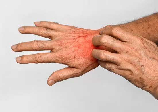 Imagem ilustrativa da imagem Governo de Minas Gerais orienta medidas de controle após surto de sarna humana