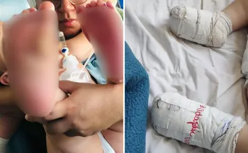 Imagem ilustrativa da imagem Bebê sofre queimaduras nos pés após pisar em chão quente em creche na Serra