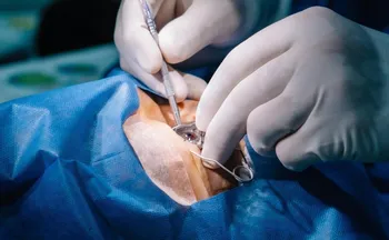 Imagem ilustrativa da imagem Cirurgia de catarata em clínica na Bahia deixa 11 pacientes sem a visão de um olho