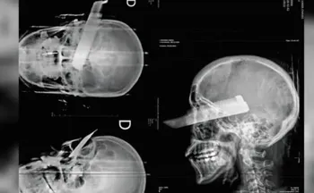 Imagem ilustrativa da imagem Mulher fica com faca cravada no olho após tentativa de feminicídio em SC