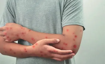 Imagem ilustrativa da imagem Saiba como se proteger da mpox; Brasil já registrou 57 casos neste ano