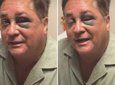 Imagem ilustrativa da imagem Cantor Leonardo sofre acidente e aparece com os olhos roxos e inchados