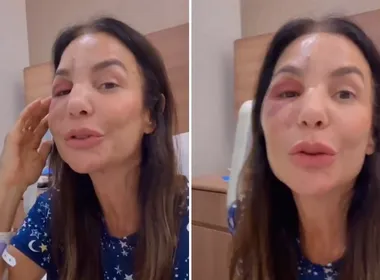 Imagem ilustrativa da imagem Ivete Sangalo ressurge após cirurgia no rosto: 'Poderia ter sido tão pior'