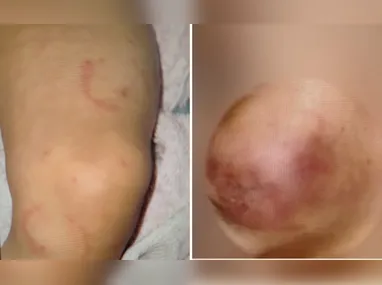 Imagem ilustrativa da imagem Mãe e padrasto são presos suspeitos de agredir bebê com mordidas em Vila Velha