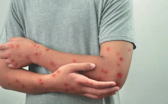 Imagem ilustrativa da imagem Saiba como se proteger da mpox; Brasil já registrou 57 casos neste ano