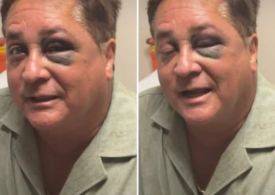 Imagem ilustrativa da imagem Cantor Leonardo sofre acidente e aparece com os olhos roxos e inchados