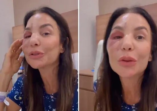 Imagem ilustrativa da imagem Ivete Sangalo ressurge após cirurgia no rosto: 'Poderia ter sido tão pior'