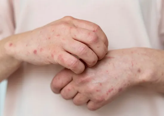 Imagem ilustrativa da imagem Ministério da Saúde emite alerta para reintrodução do sarampo após a Copa do Mundo