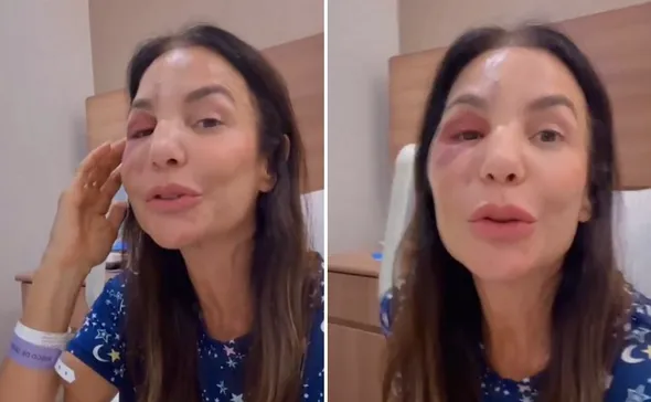 Imagem ilustrativa da imagem Ivete Sangalo ressurge após cirurgia no rosto: 'Poderia ter sido tão pior'