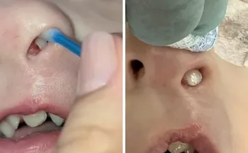 Imagem ilustrativa da imagem Em caso raro, dente nasce dentro do nariz de criança de 3 anos no Paraná